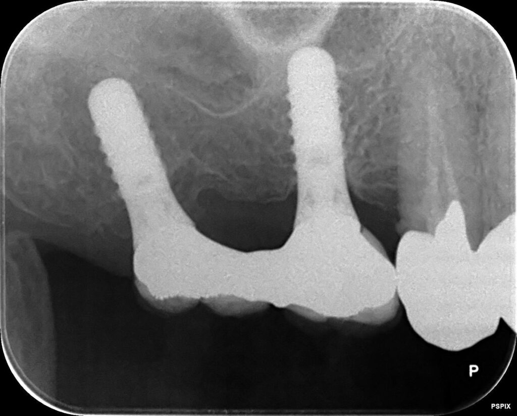 20年経過後のレントゲン写真