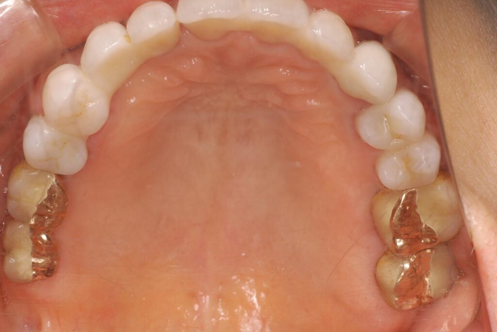 20年経過後の口腔内写真