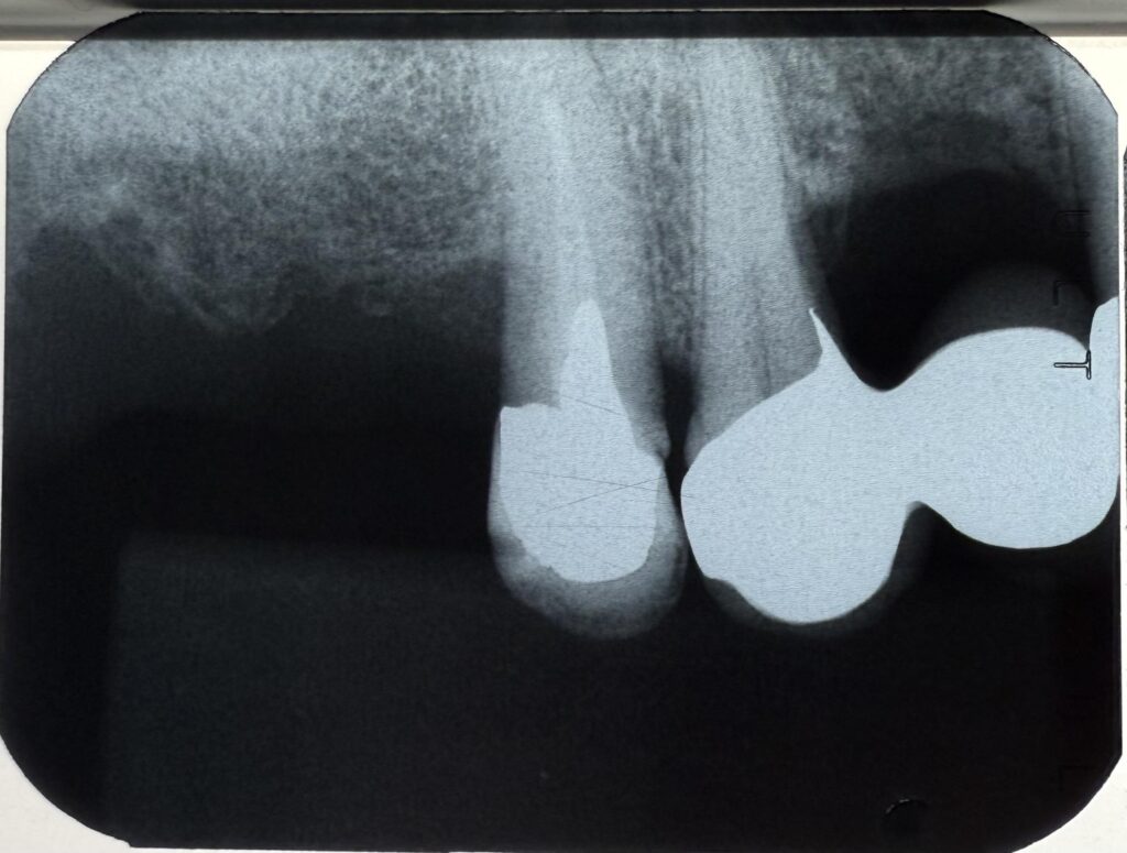 術前のレントゲン写真