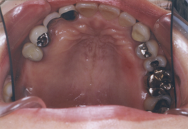 術前の口腔内写真