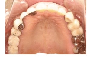 インプラント手術後の口腔内写真