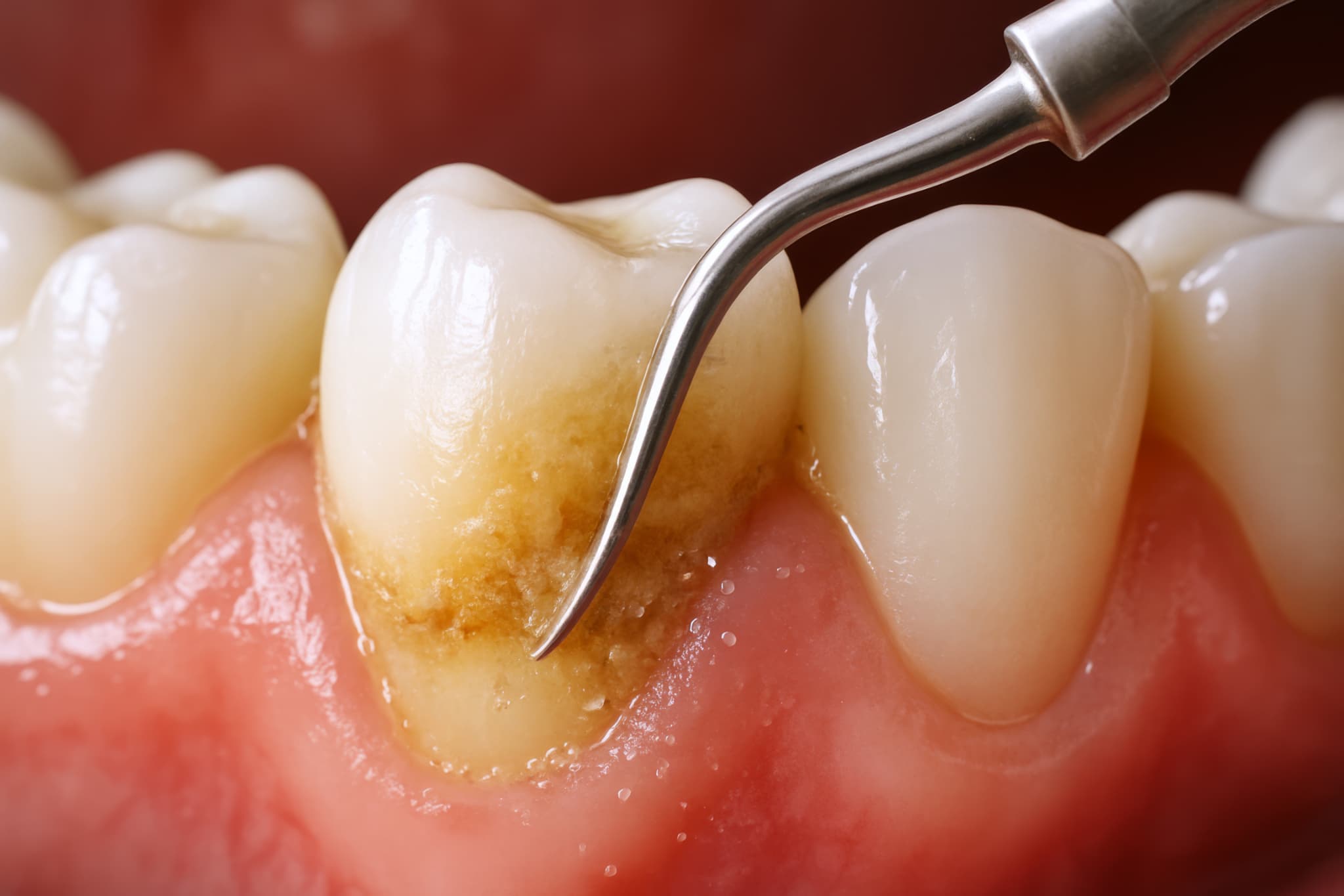 歯周病の治療で行うスケーリングの様子