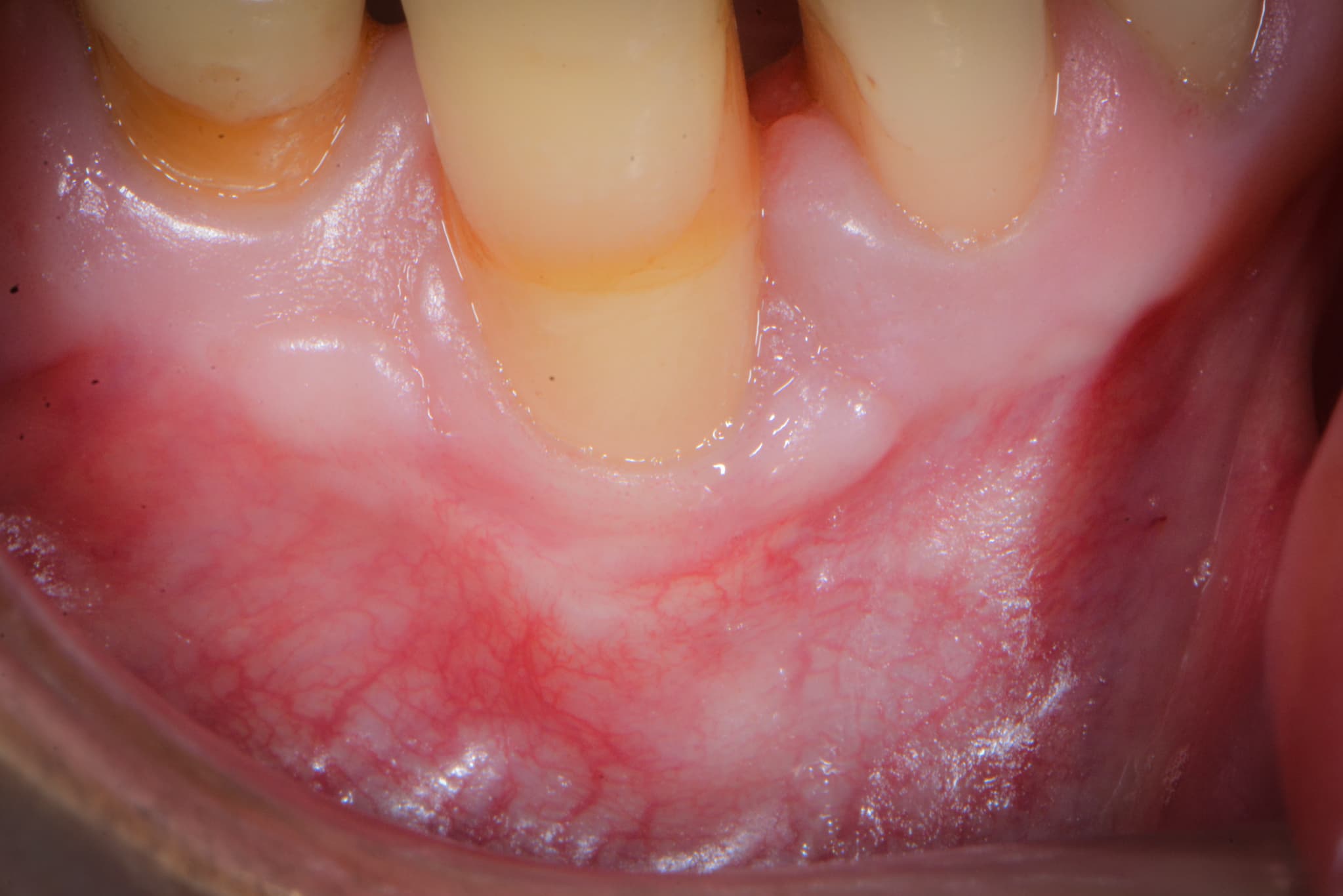 重度の歯周病になり歯茎が下がった様子